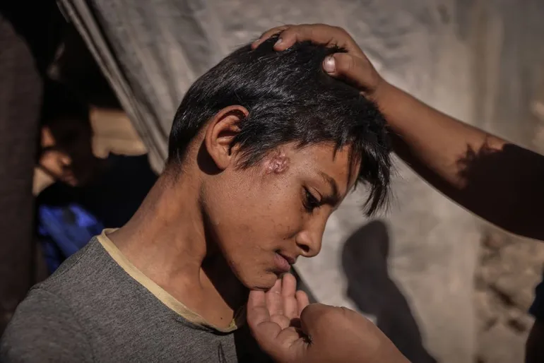  انتشار "الأمراض الجلدية" في أكثر من 478 مخيماً للنازحين شمال غرب سوريا